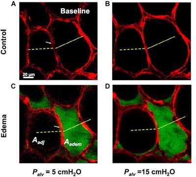 Mechanical Ventilation Lessons Learned From Alveolar Micromechanics